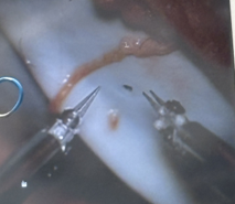 Nerve reconstruction